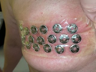 L'élimination des Punaises des titties