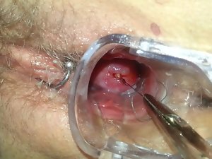 Mirena Spirale의 ziehen 제거 IUD IUP의 entfernen